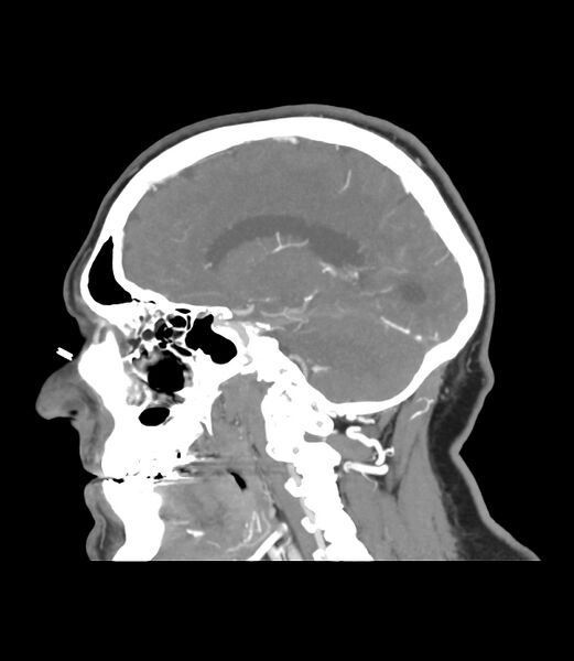 File:Cerebral dural venous sinus thrombosis (Radiopaedia 86514-102576 C 35).jpg