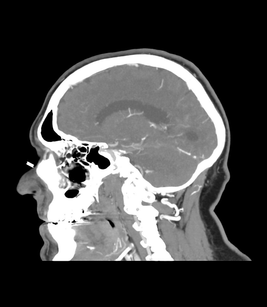 Cerebral dural venous sinus thrombosis (Radiopaedia 86514-102576 C 35).jpg