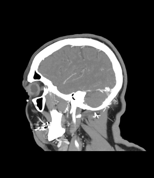 File:Cerebral dural venous sinus thrombosis (Radiopaedia 86514-102576 C 47).jpg