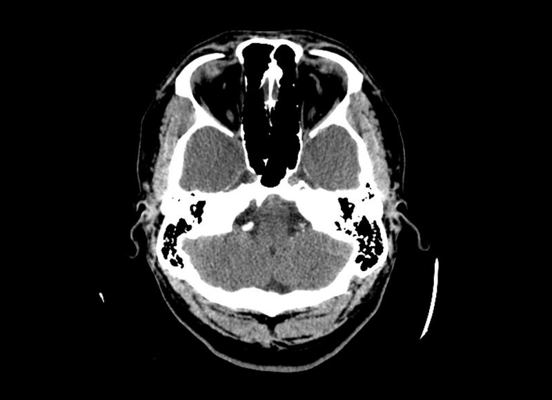File:Cerebral edema (Radiopaedia 82519-96661 Axial non-contrast 44).jpg