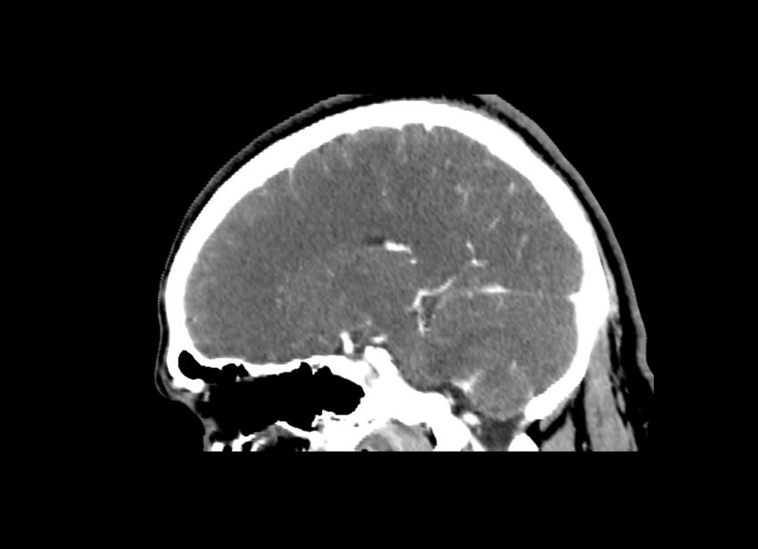 Cerebral edema (Radiopaedia 82519-96661 D 32).jpg