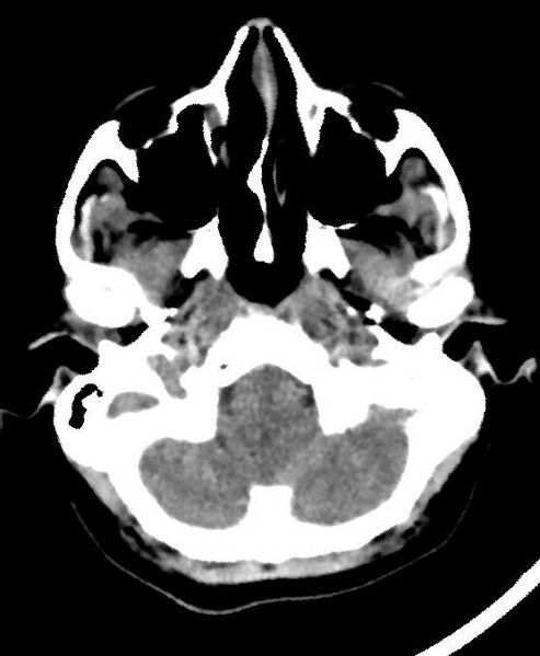 File:Cerebral edema due to severe hyponatremia (Radiopaedia 89826-106937 Axial non-contrast 12).jpg