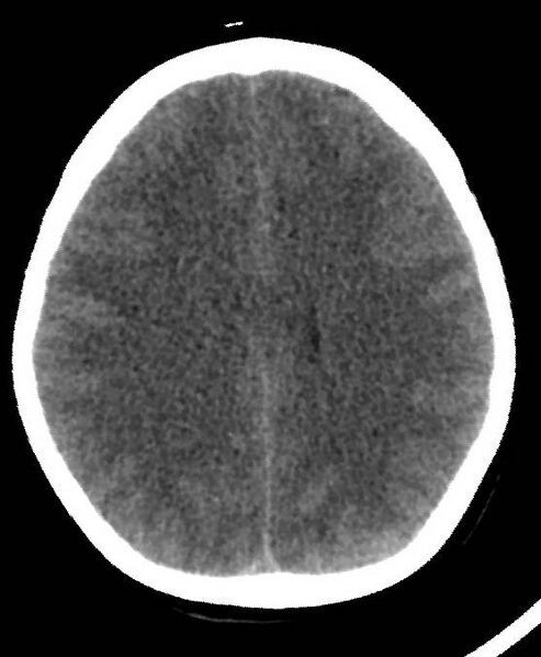 File:Cerebral edema due to severe hyponatremia (Radiopaedia 89826-106937 Axial non-contrast 59).jpg