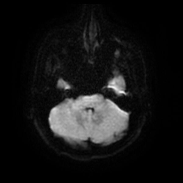 File:Cerebral fat embolism (Radiopaedia 37510-39363 Axial DWI 8).jpg