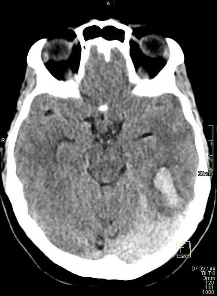 File:Cerebral venous sinus thrombosis (Radiopaedia 91329-108965 Axial non-contrast 19).jpg