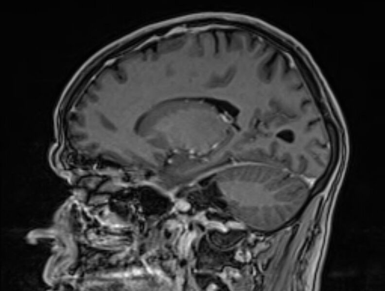 File:Cerebral venous thrombosis (Radiopaedia 71207-81504 Sagittal T1 C+ 39).jpg