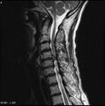 Cervical disc extrusion (Radiopaedia 5216-6982 Sagittal T2 1).jpg