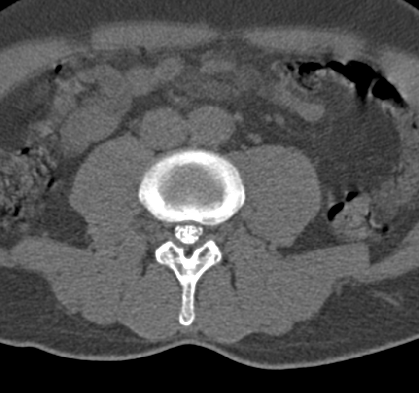 Cervical dural CSF leak on MRI and CT treated by blood patch (Radiopaedia 49748-54996 B 105).png