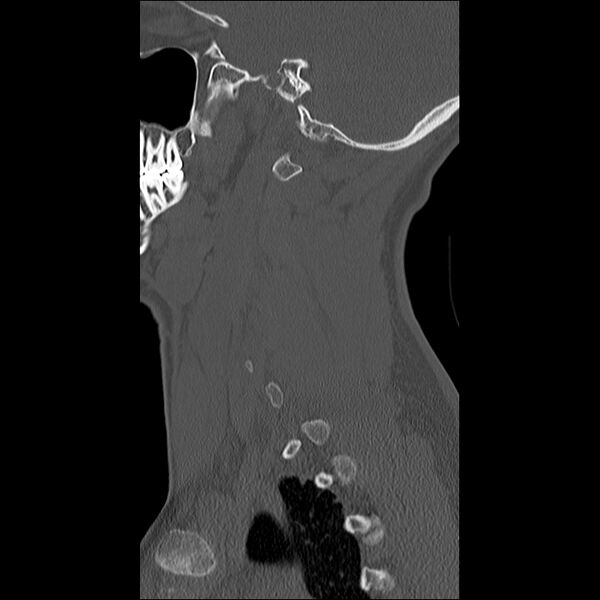 File:Cervical facet fracture and anterior discoligamentous injury (Radiopaedia 32139-33083 Sagittal bone window 34).jpg