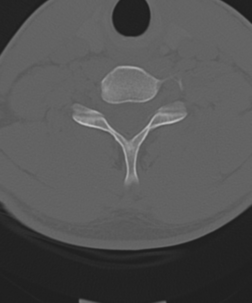 File:Cervical intercalary bone (Radiopaedia 35211-36748 Axial bone window 46).png