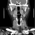 Cervical lymphadenopathy- cause unknown (Radiopaedia 22420-22457 C 15).jpg