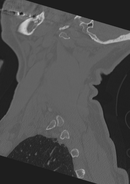 File:Cervical spine fractures with vertebral artery dissection (Radiopaedia 53296-59268 Sagittal bone window 61).png