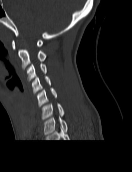 File:Cervical spine posterior ligamentous complex rupture (Radiopaedia 63486-72101 Sagittal bone window 16).jpg