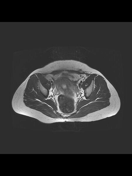 File:Cesarean section scar endometrioma (Radiopaedia 56569-63297 Axial T2 14).jpg