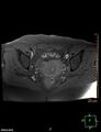 Cesarian scar endometriosis (Radiopaedia 68495-78066 Axial T1 fat sat 15).jpg