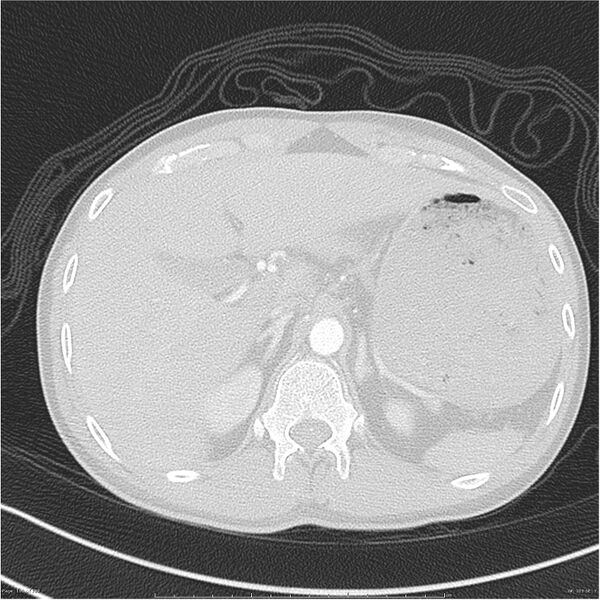 File:Chest and abdomen multi-trauma (Radiopaedia 26294-26425 lung window 103).jpg