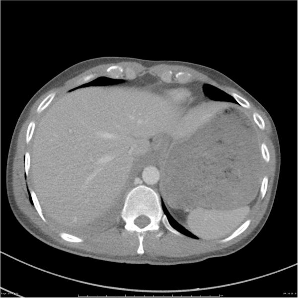 File:Chest and abdomen multi-trauma (Radiopaedia 26294-26426 bone window 16).jpg
