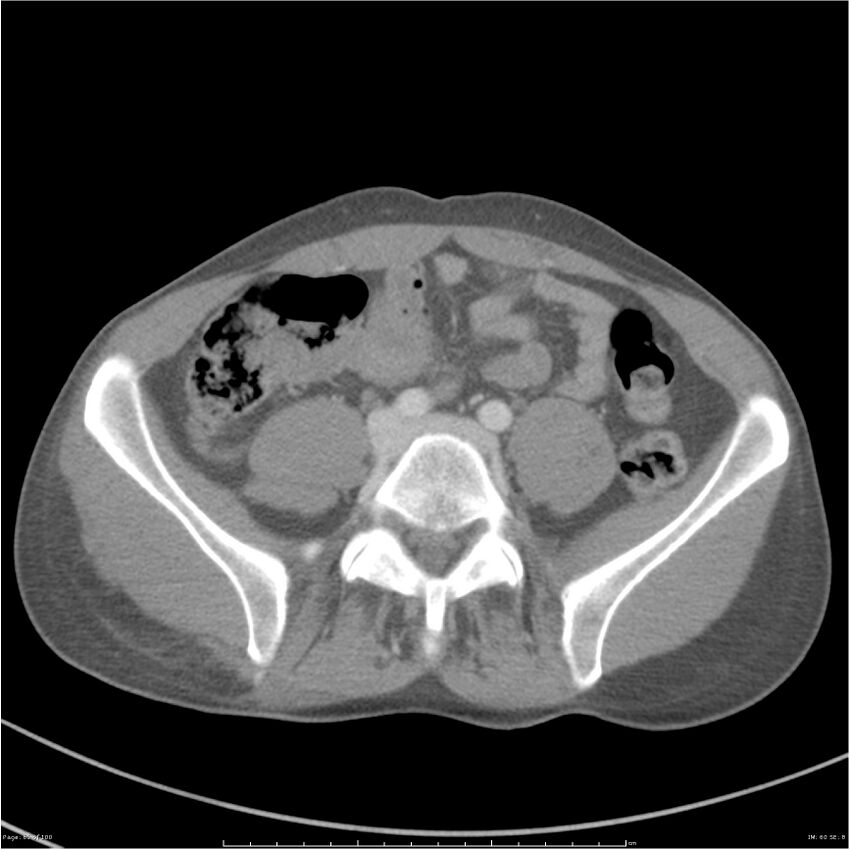Chest and abdomen multi-trauma (Radiopaedia 26294-26426 bone window 60).jpg