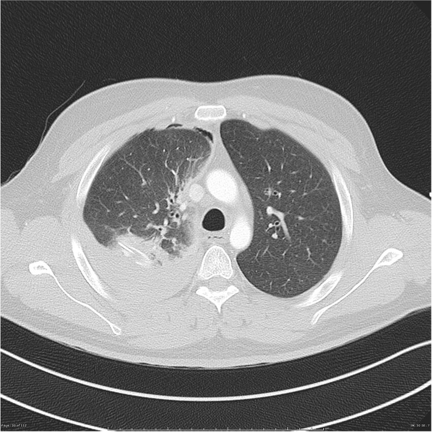 Chest stabbing (Radiopaedia 29089-29462 Axial lung window 30).jpg