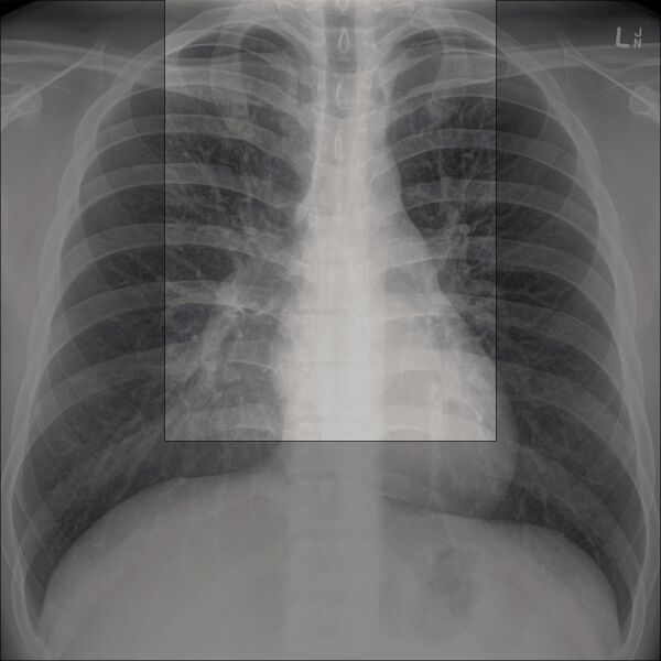 File:Chest x-ray - airway (Radiopaedia 32554-33506 A 1).jpg