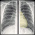 Chest x-ray - breathing (Radiopaedia 32556-33507 G 1).jpg