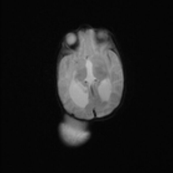 File:Chiari III malformation with occipital encephalocele (Radiopaedia 79446-92559 Axial DWI 13).jpg