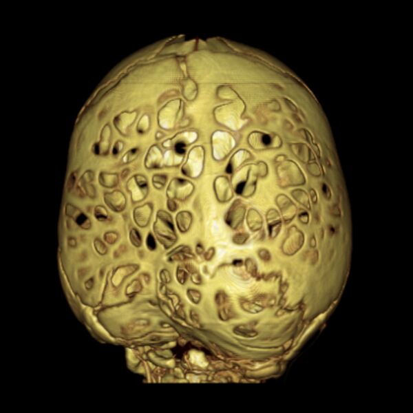 File:Chiari I and severe copper beaten skull (Radiopaedia 5993-7504 D 1).jpg