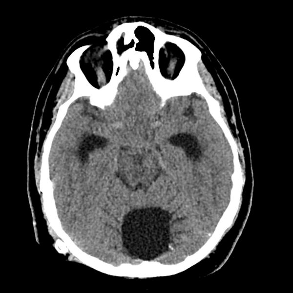 File:Chiasmatic-hypothalamic juvenile pilocytic astrocytoma (Radiopaedia 78533-91237 Axial non-contrast 22).jpg