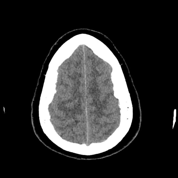 File:Chiasmatic-hypothalamic juvenile pilocytic astrocytoma (Radiopaedia 78533-91237 Axial non-contrast 48).jpg