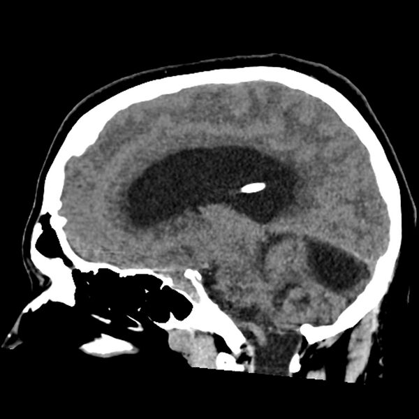 File:Chiasmatic-hypothalamic juvenile pilocytic astrocytoma (Radiopaedia 78533-91237 B 36).jpg