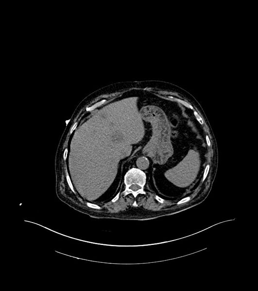 File:Cholangiocarcinoma with cerebral metastases (Radiopaedia 83519-98629 Axial non-contrast 16).jpg
