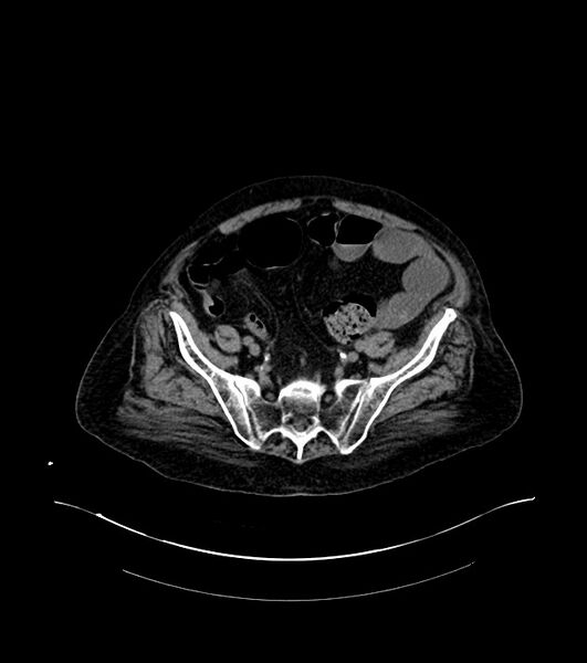 File:Cholangiocarcinoma with cerebral metastases (Radiopaedia 83519-98629 Axial non-contrast 97).jpg