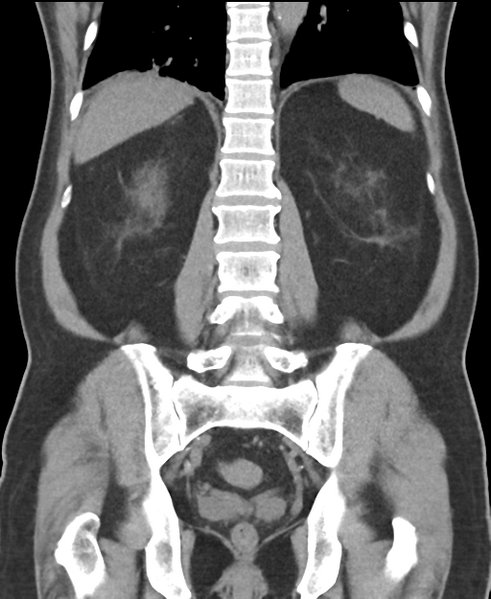 File:Cholecystitis with focal perforation and hepatic abscess (Radiopaedia 37189-38945 Coronal non-contrast 42).png