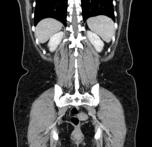 File:Choledocholithiasis on CT and MRI (Radiopaedia 24825-25087 C 42).jpg