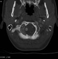 Chondroblastoma - occipital condyle (Radiopaedia 5569-7304 bone window 6).jpg