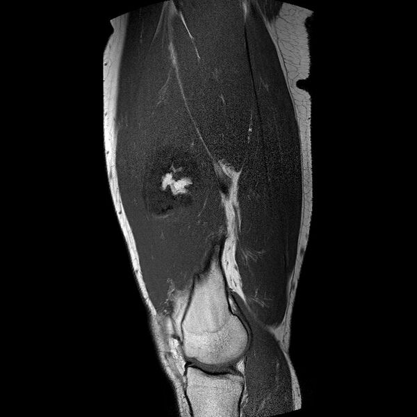 File:Chondrosarcoma arising from exostosis (Radiopaedia 59996-67686 Sagittal T1 TSE 8).jpg