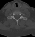 Chordoma (C4 vertebra) (Radiopaedia 47561-52188 Axial bone window 37).png