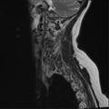 Chordoma (C4 vertebra) (Radiopaedia 47561-52189 Sagittal T2 14).png