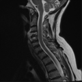 Chordoma (C4 vertebra) (Radiopaedia 47561-52189 Sagittal T2 6).png