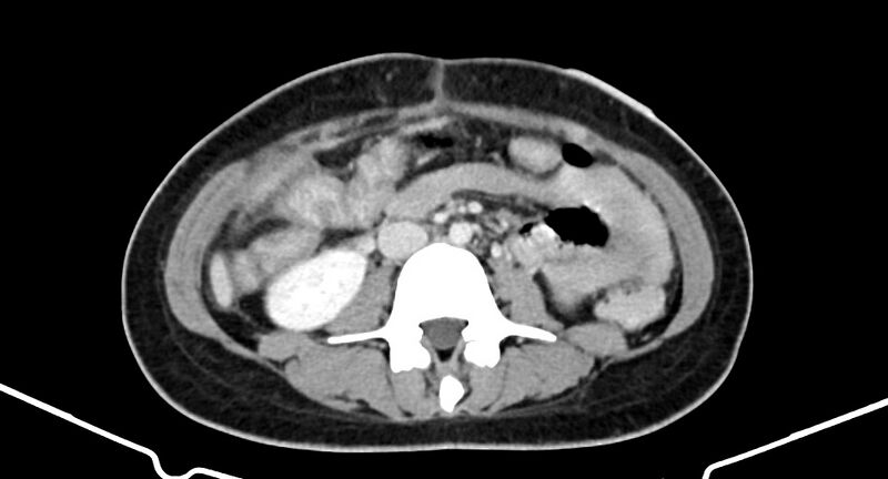 File:Choriocarcinoma liver metastases (Radiopaedia 74768-85766 A 116).jpg