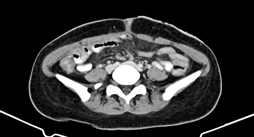 Choriocarcinoma liver metastases (Radiopaedia 74768-85766 A 137).jpg