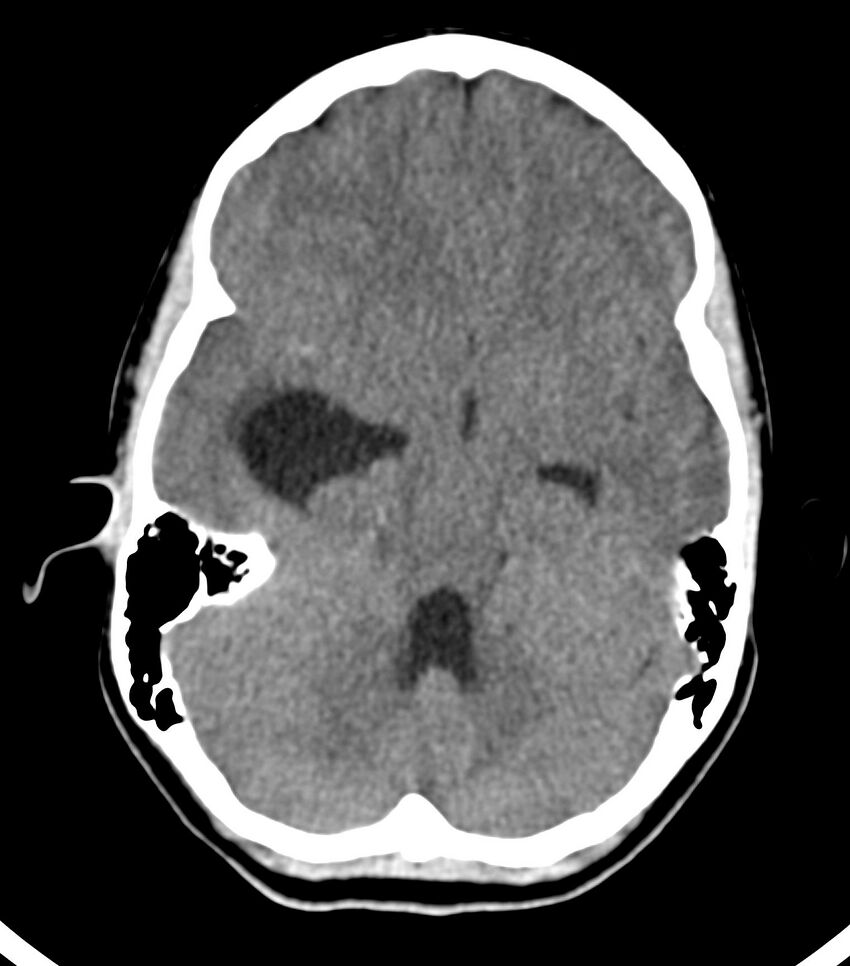 Choroid plexus carcinoma (Radiopaedia 91013-108552 Axial non-contrast 22).jpg