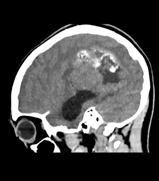File:Choroid plexus carcinoma (Radiopaedia 91013-108552 B 53).jpg