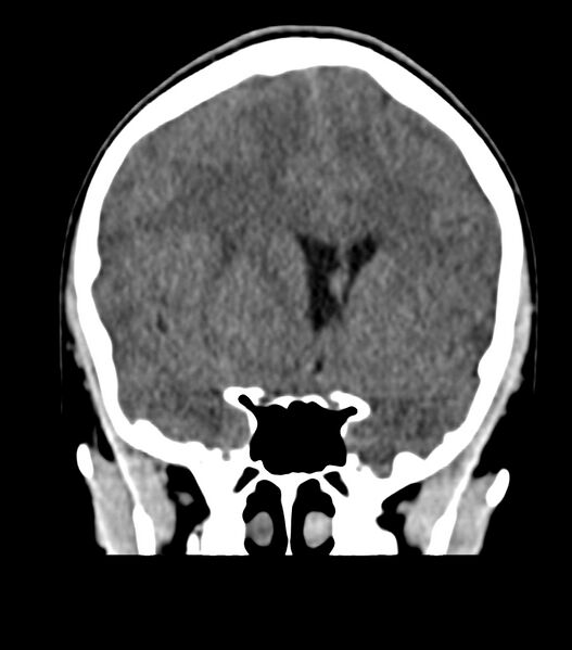 File:Choroid plexus carcinoma (Radiopaedia 91013-108552 Coronal non-contrast 32).jpg