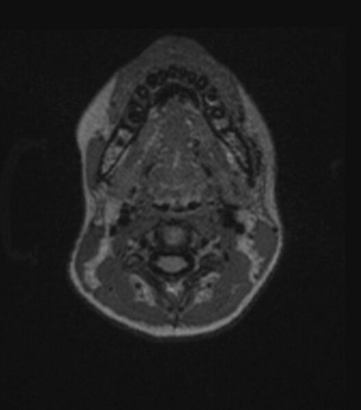 File:Choroid plexus carcinoma (Radiopaedia 91013-108553 Axial FLAIR C+ 30).jpg