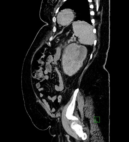 File:Chromophobe renal cell carcinoma (Radiopaedia 84239-99519 G 29).jpg