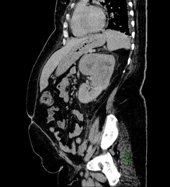 File:Chromophobe renal cell carcinoma (Radiopaedia 84239-99519 G 42).jpg