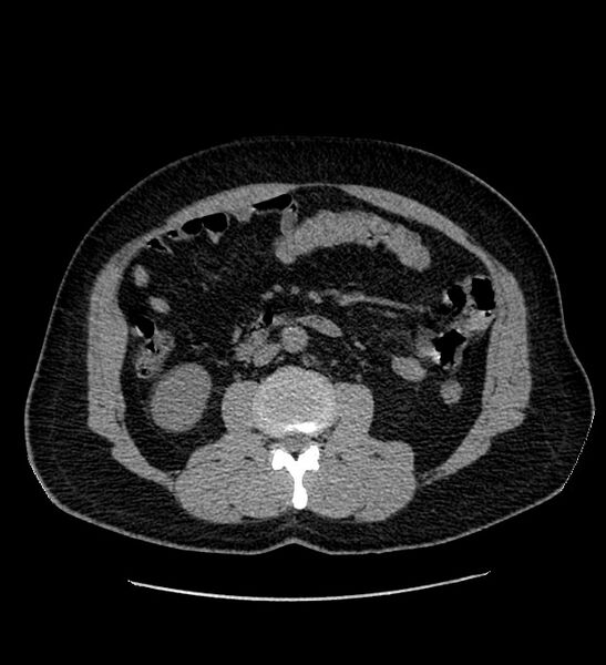 File:Chromophobe renal cell carcinoma (Radiopaedia 84337-99693 Axial non-contrast 69).jpg