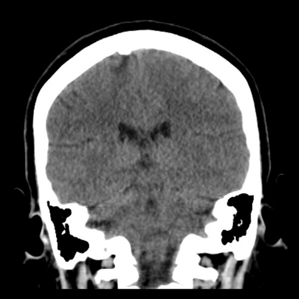 File:Chronic bilateral occipital lobe infarcts (Radiopaedia 31276-31996 Coronal non-contrast 31).jpg
