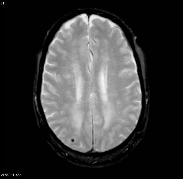 File:Chronic hypertensive encephalopathy (Radiopaedia 4564-6686 Axial Gradient Echo 13).jpg
